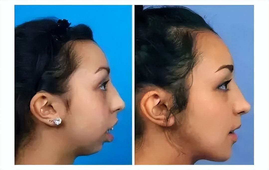 深覆颌深覆盖什么情况下不用矫正,深覆盖和深覆颌哪个严重些