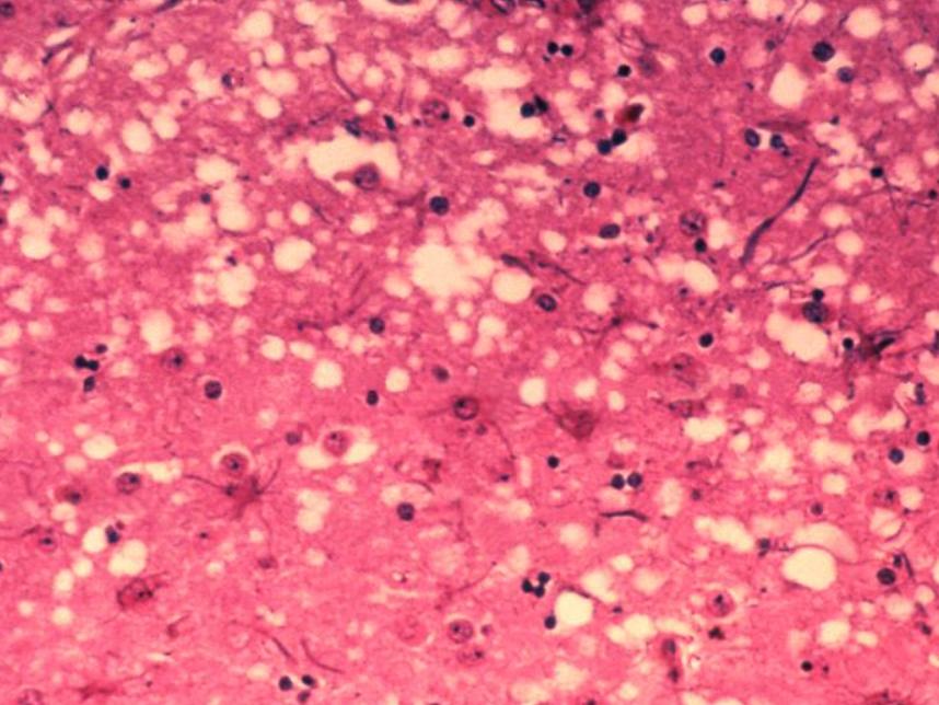 最可怕的朊病毒是什么,世界上最可怕的朊病毒