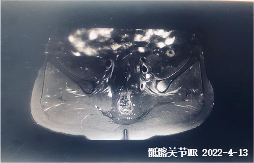 强直性脊柱炎怎么通过运动改善,目前治疗强直性脊柱炎最好的办法