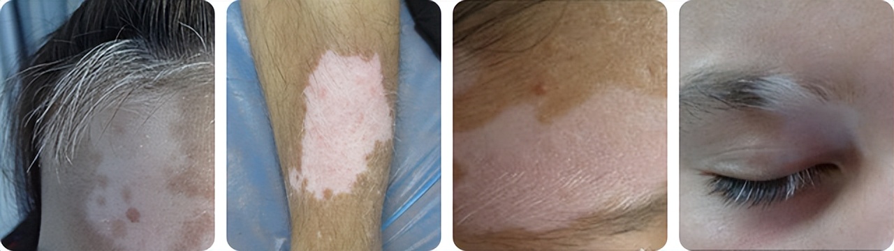 汗毛变白是不是已经变成白癜风了,毛囊型的白癜风会导致毛发变白么