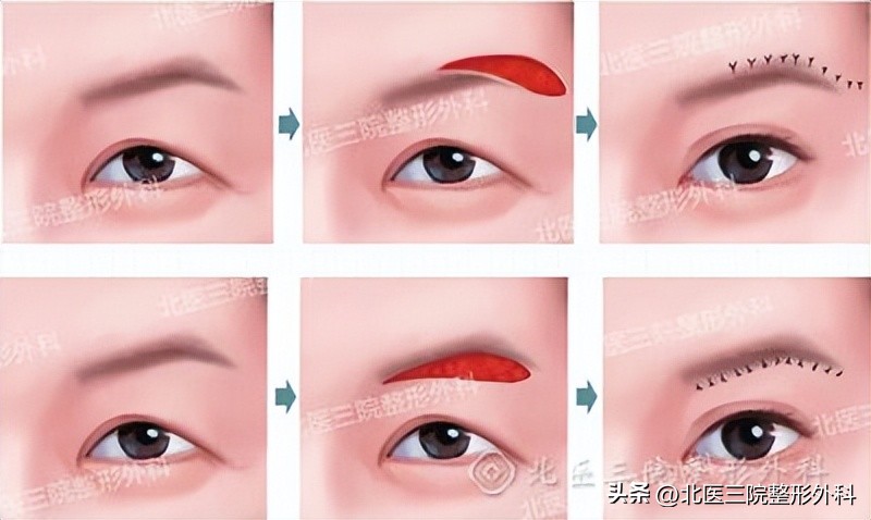 双眼皮皮肤松弛怎么办,双眼皮多年后眼皮松弛怎么办