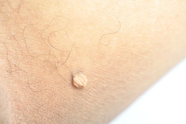 身上慢慢长肉疙瘩是什么病的前兆,身上小肉疙瘩会癌变吗