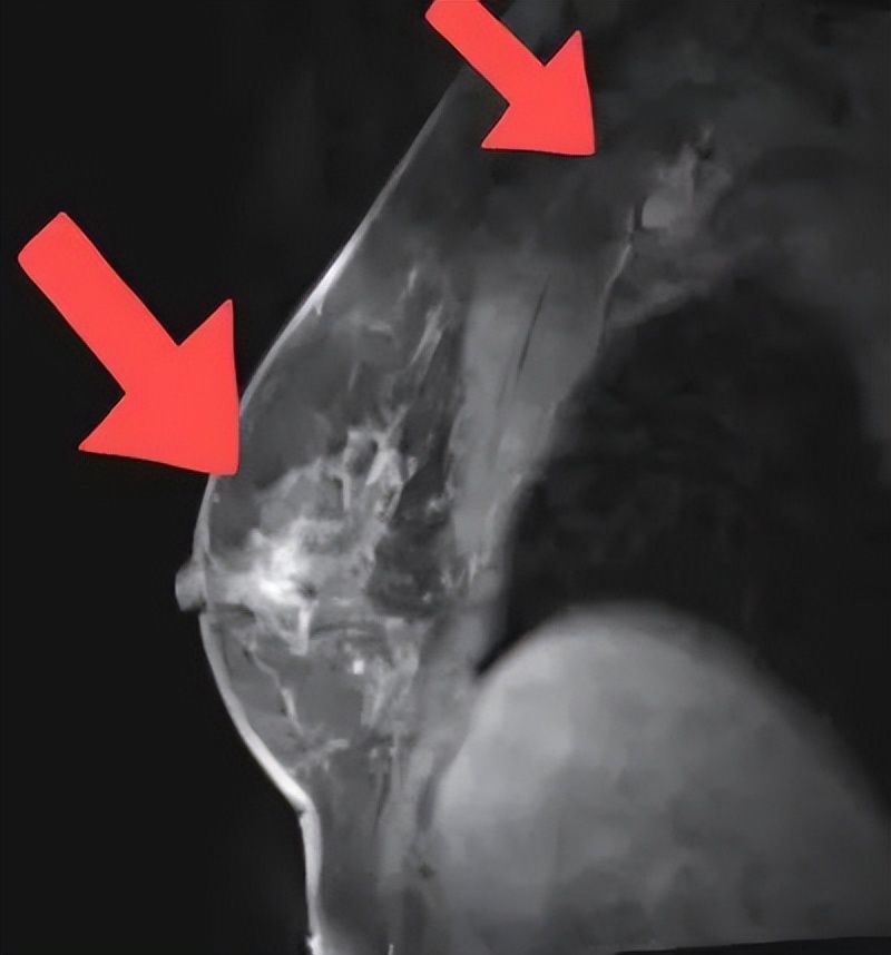 汉曲优曲妥珠单抗治疗效果,her2阳性乳腺癌新辅助治疗的启示