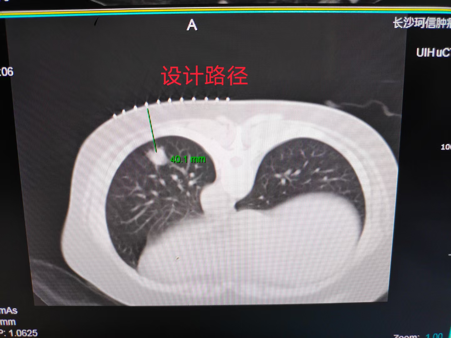 11厘米肺癌肿瘤粒子植入,肺癌多处转移放射治疗全过程