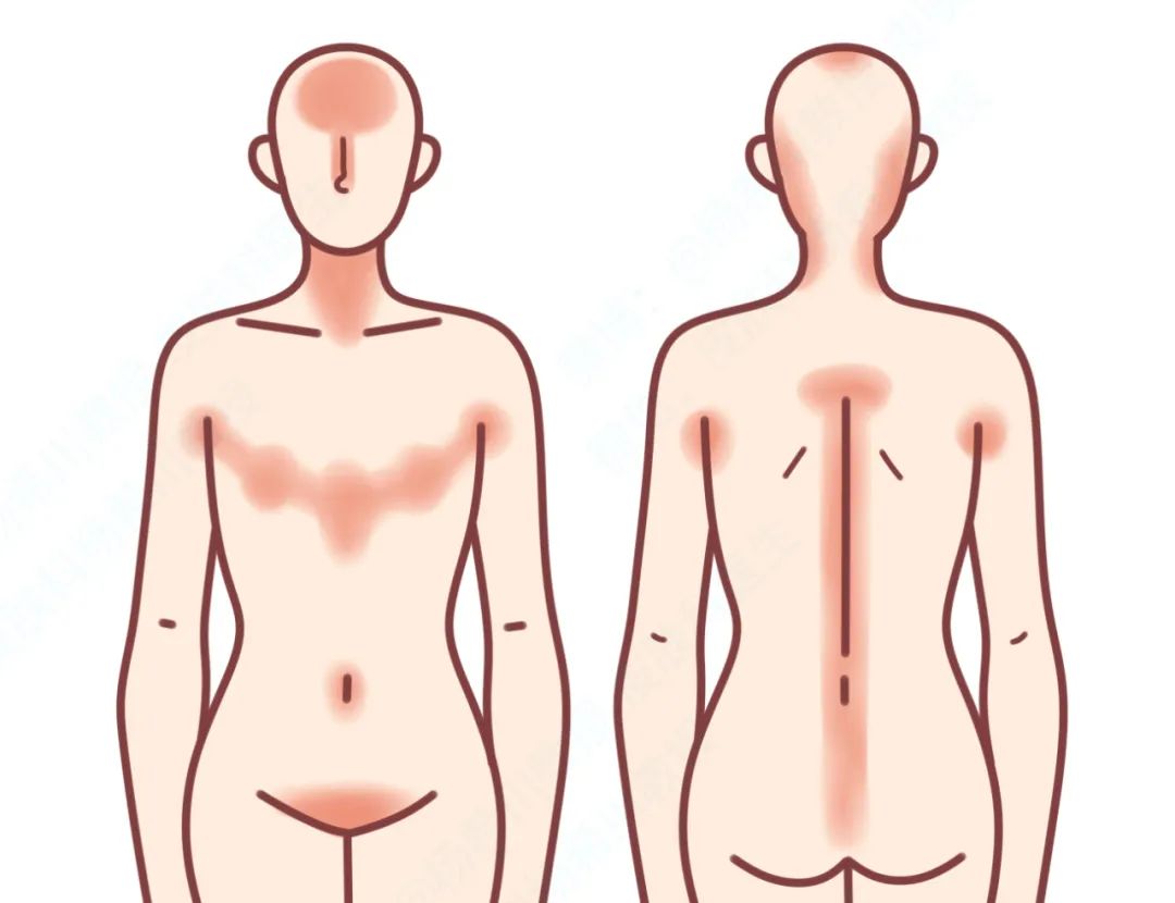 身上老是洗不干净是怎么回事,洗完澡皮肤干痒起白皮屑怎么回事