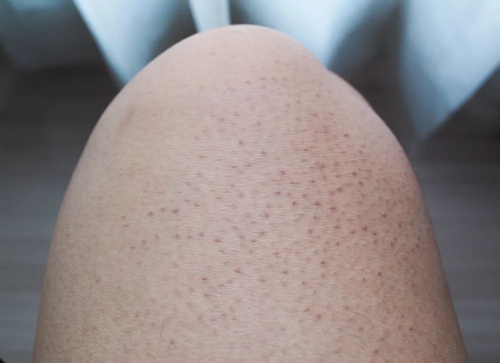 鼻子周围起疙瘩怎么回事,鼻子周围红肿起疙瘩吃什么药