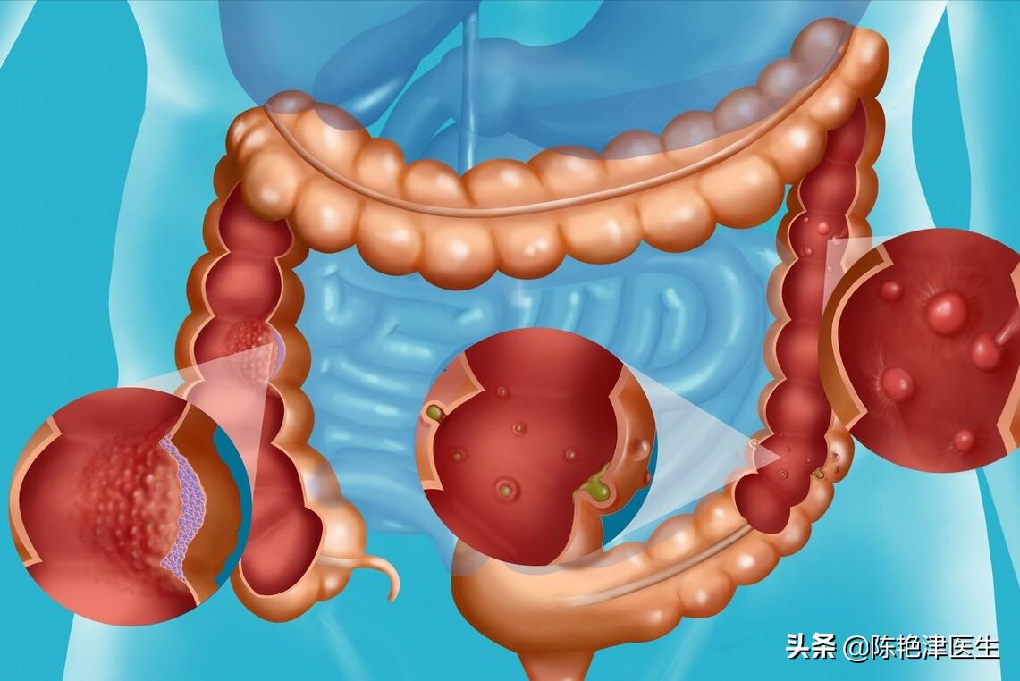 肠息肉是肠癌最大的祸根,肠息肉有癌变风险中医怎么预防