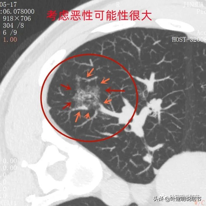 误诊肺纤维化,肺蜂窝状是癌吗