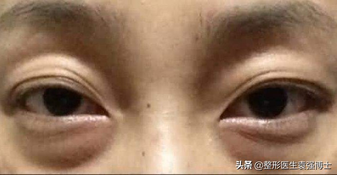 想彻底解决眼袋,想做除眼袋手术怎么和医生沟通