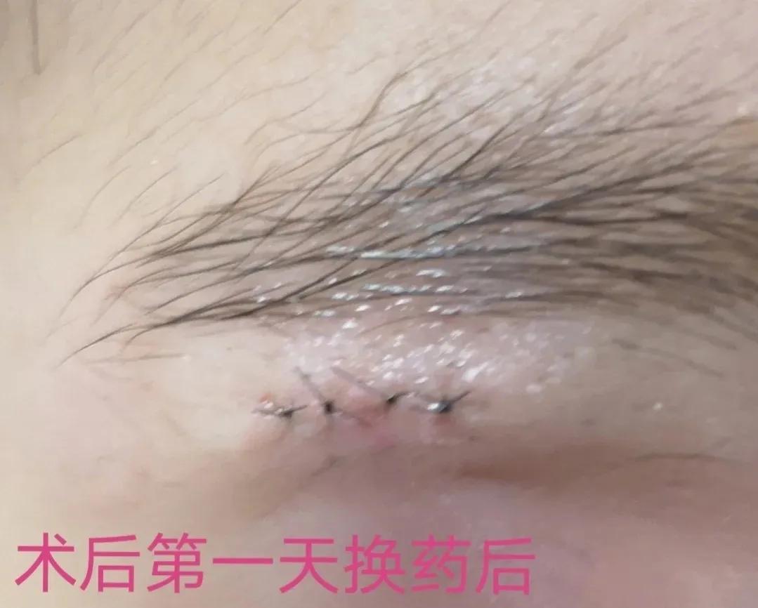 皮脂腺囊肿和粉刺瘤,火针治疗皮脂腺囊肿