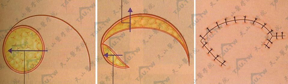 嘴巴缺了一小块肉多久能好,嘴巴好像缺了一块肉怎么回事