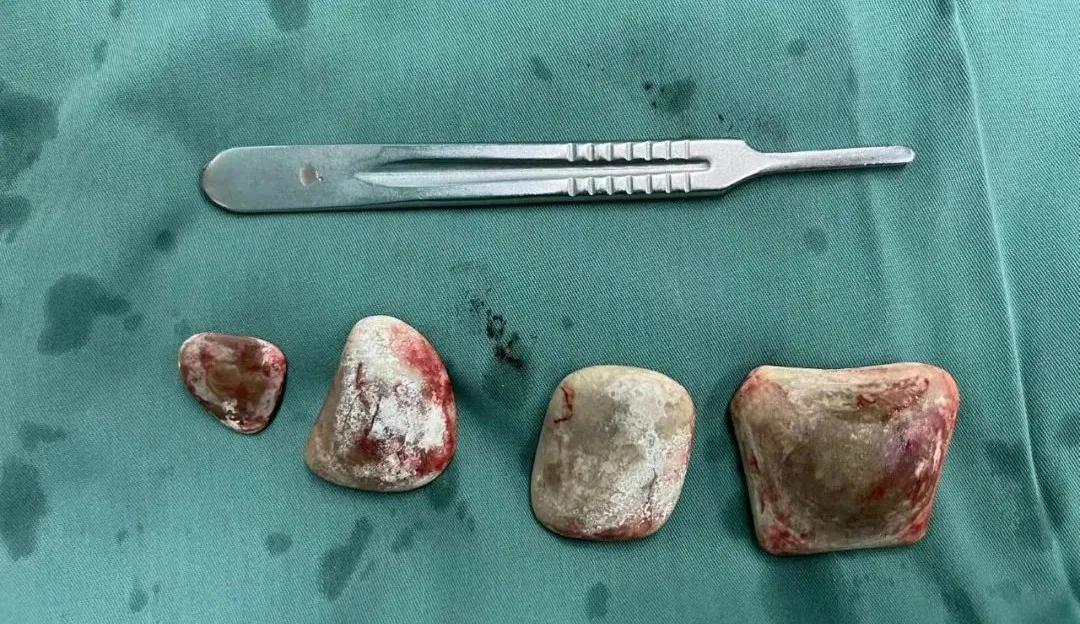 北京治疗泌尿结石最好的专家,泌尿结石排石操