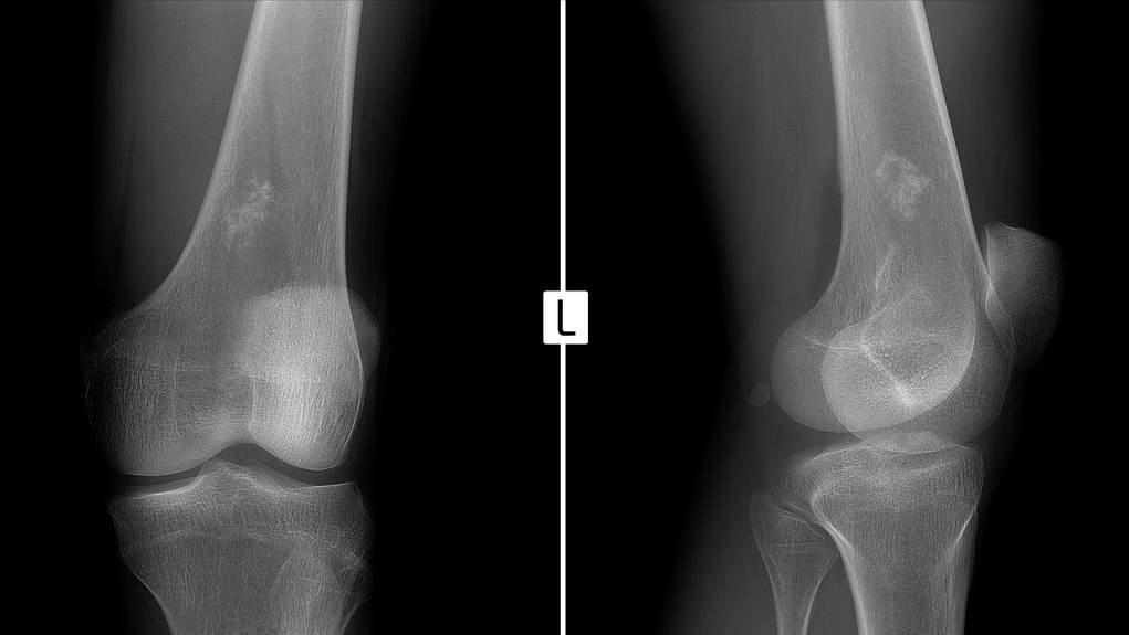 肉瘤容易误诊吗,肉瘤是不治之症吗