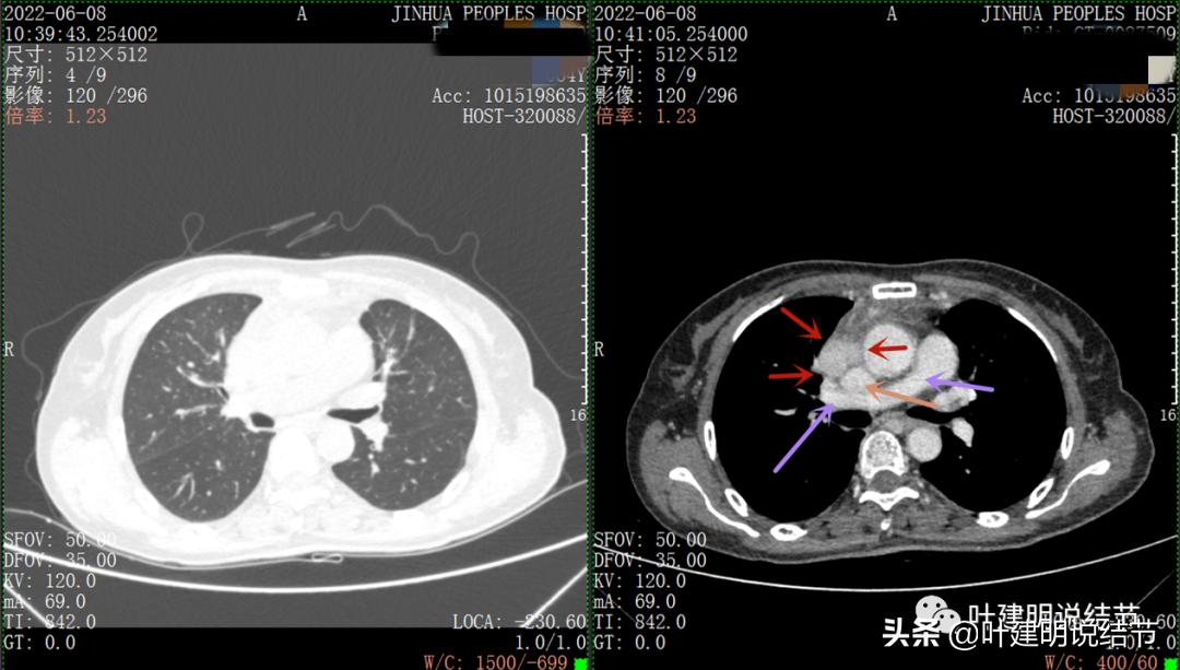 这位老乡，乏力来查，查出这么大个的纵隔肿瘤！会是什么呢？