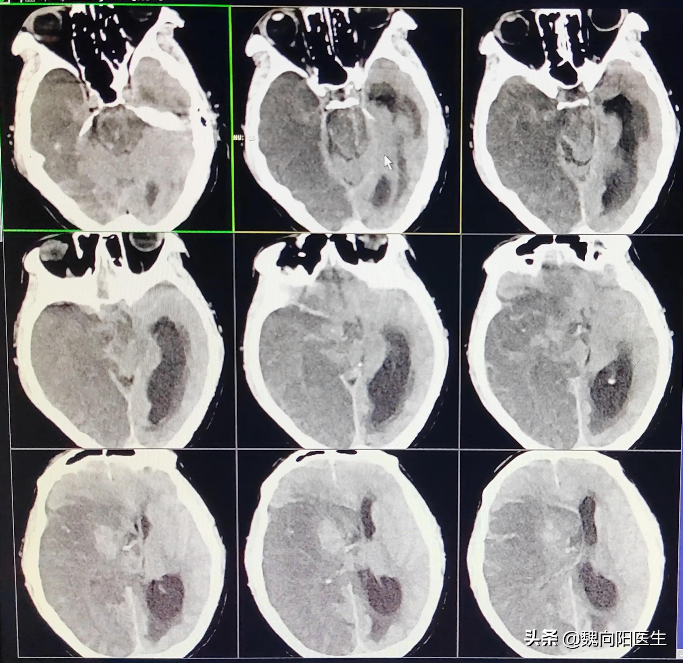 颈静脉血栓能完全溶掉吗,颈动脉血栓能用针管抽吗