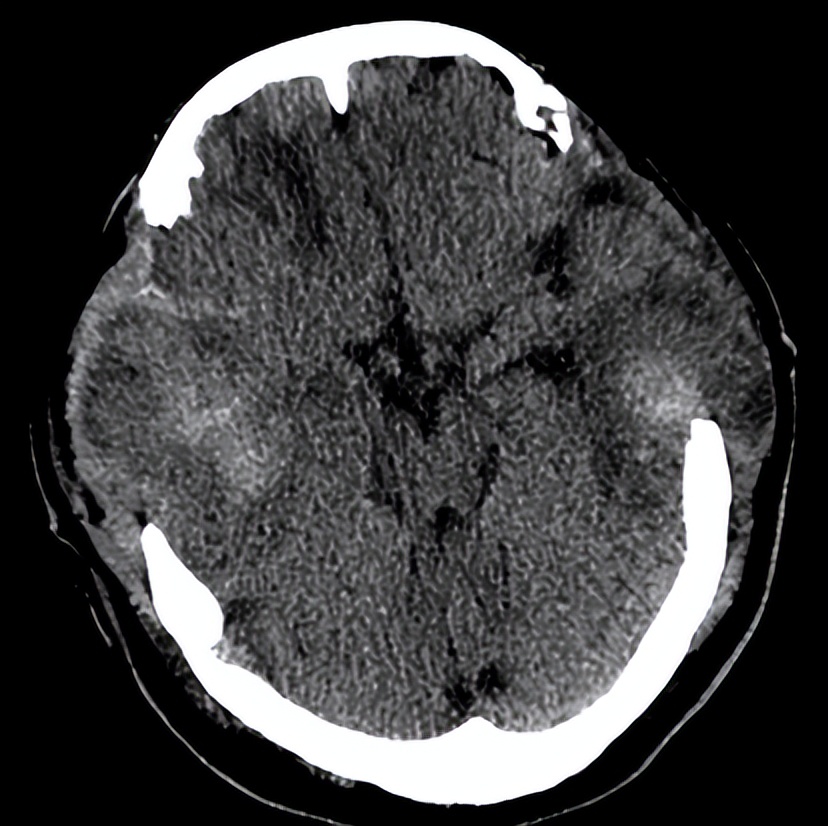 医院成功救治重型颅脑患者,特重型颅脑损伤治愈案