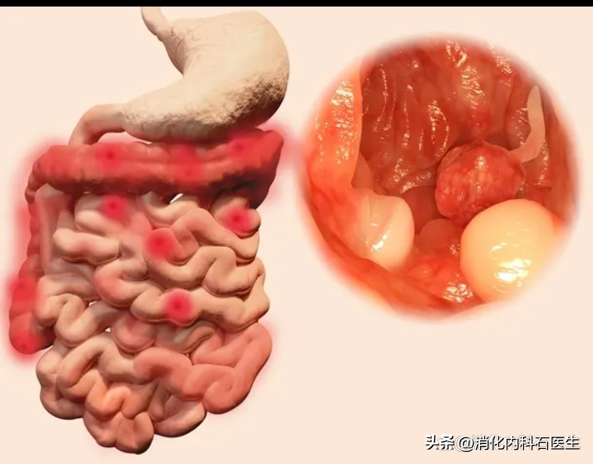 儿童肠息肉2.5公分,小孩结肠息肉用b超能查出来吗