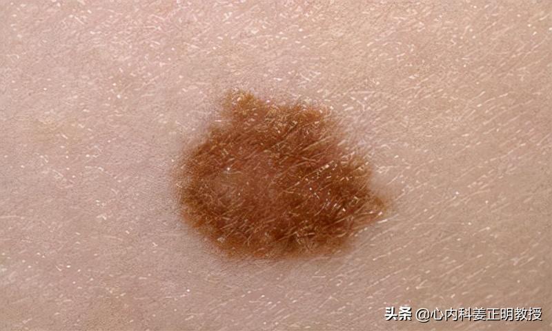 老年斑是只有老年人才会有的吗,老年人长老年斑对身体有影响吗