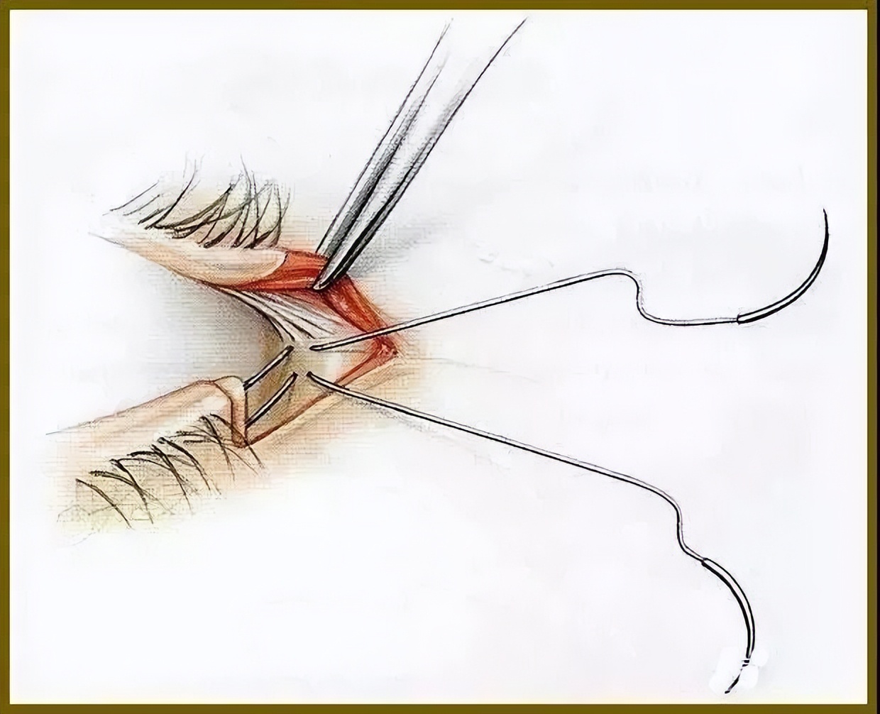 除皱用哪种方法比较好,除皱效果最好的几种方法