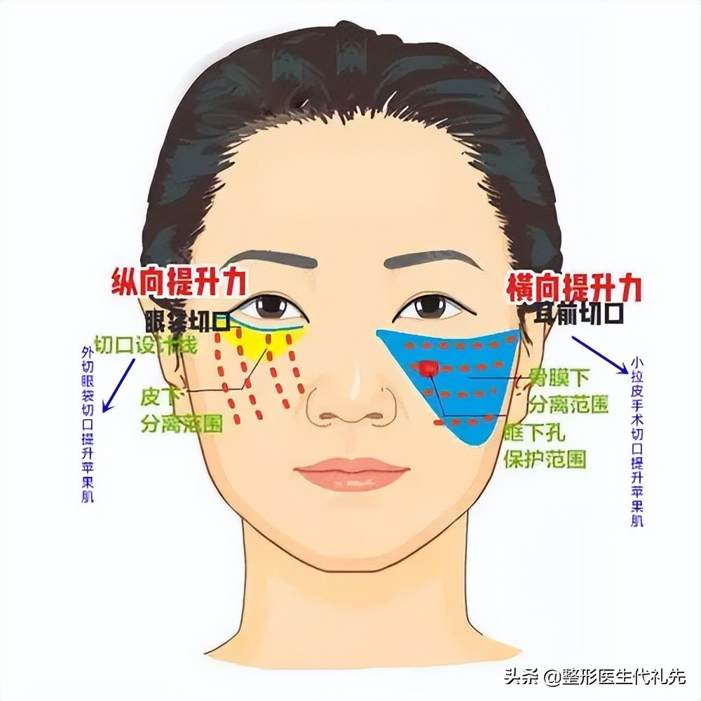 去法令纹现在最有效的方法是什么,去除法令纹的最有效的方法有哪些
