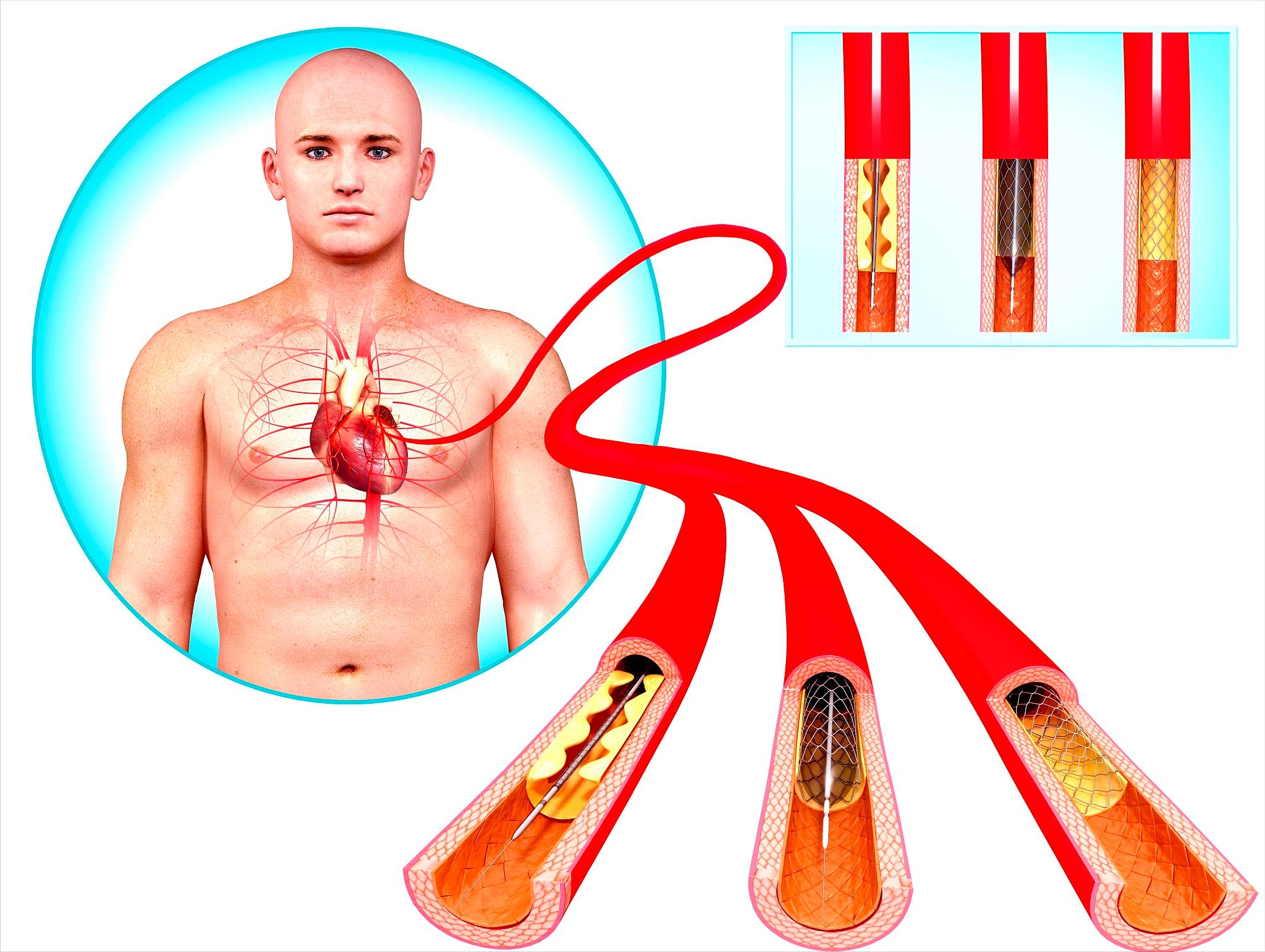 4味猛药打通全身的血管淤堵,降血脂溶血栓吃啥药好
