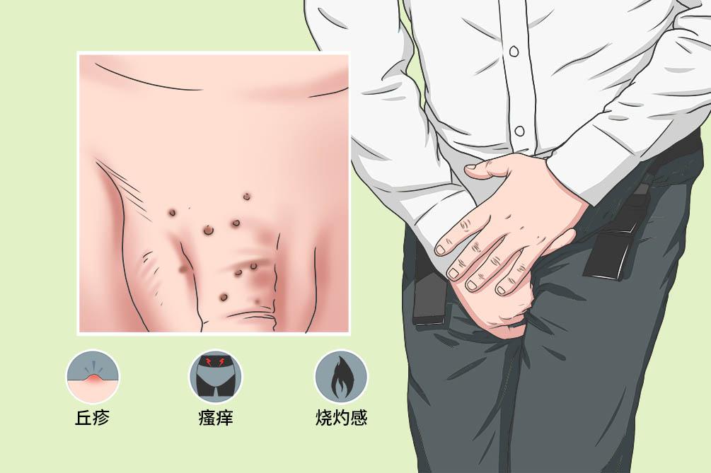 每个人身上都有疣,身上四种疣