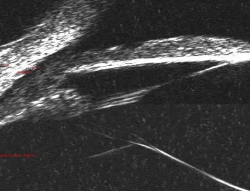 囊袋张力环的选择,囊袋张力环与预装式张力环
