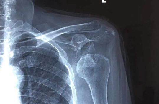 年轻人肩膀痛的治疗方法,整天肩膀酸痛怎么检查病因