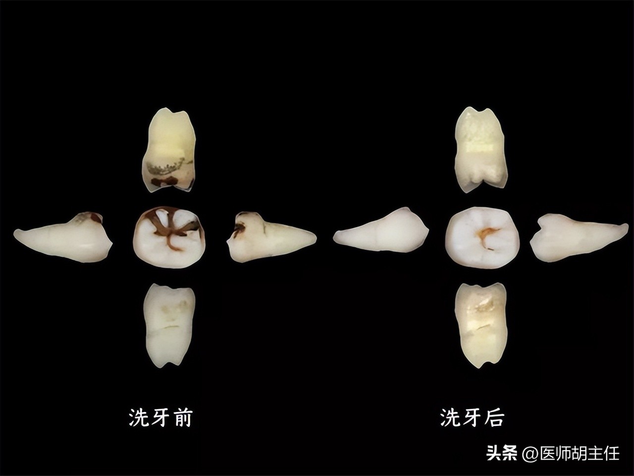清理牙缝牙结石最有效方法,如何清除牙缝里的牙结石