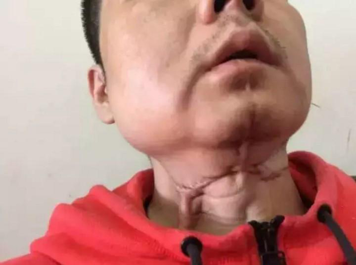 槟榔危害性有多大安全性又有多大,槟榔危害的真实案例