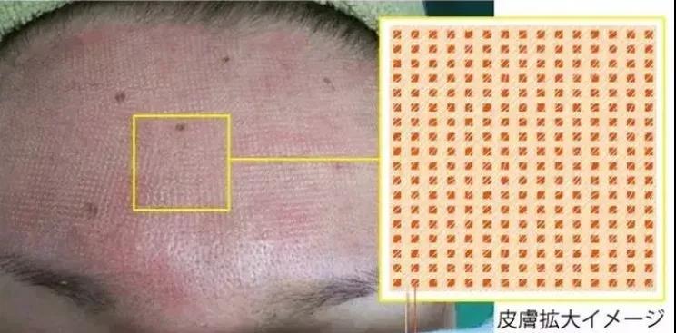 痤疮留下痘坑痘印怎么消除男生,男士修复痘印痘坑最好的护肤品