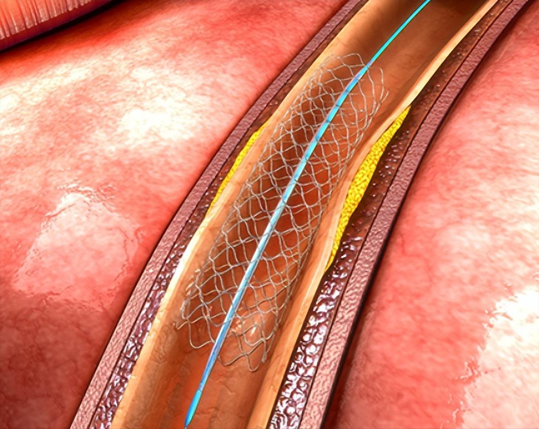 心脏支架手术一般能活多少年,做了心脏支架正常情况能活多少年
