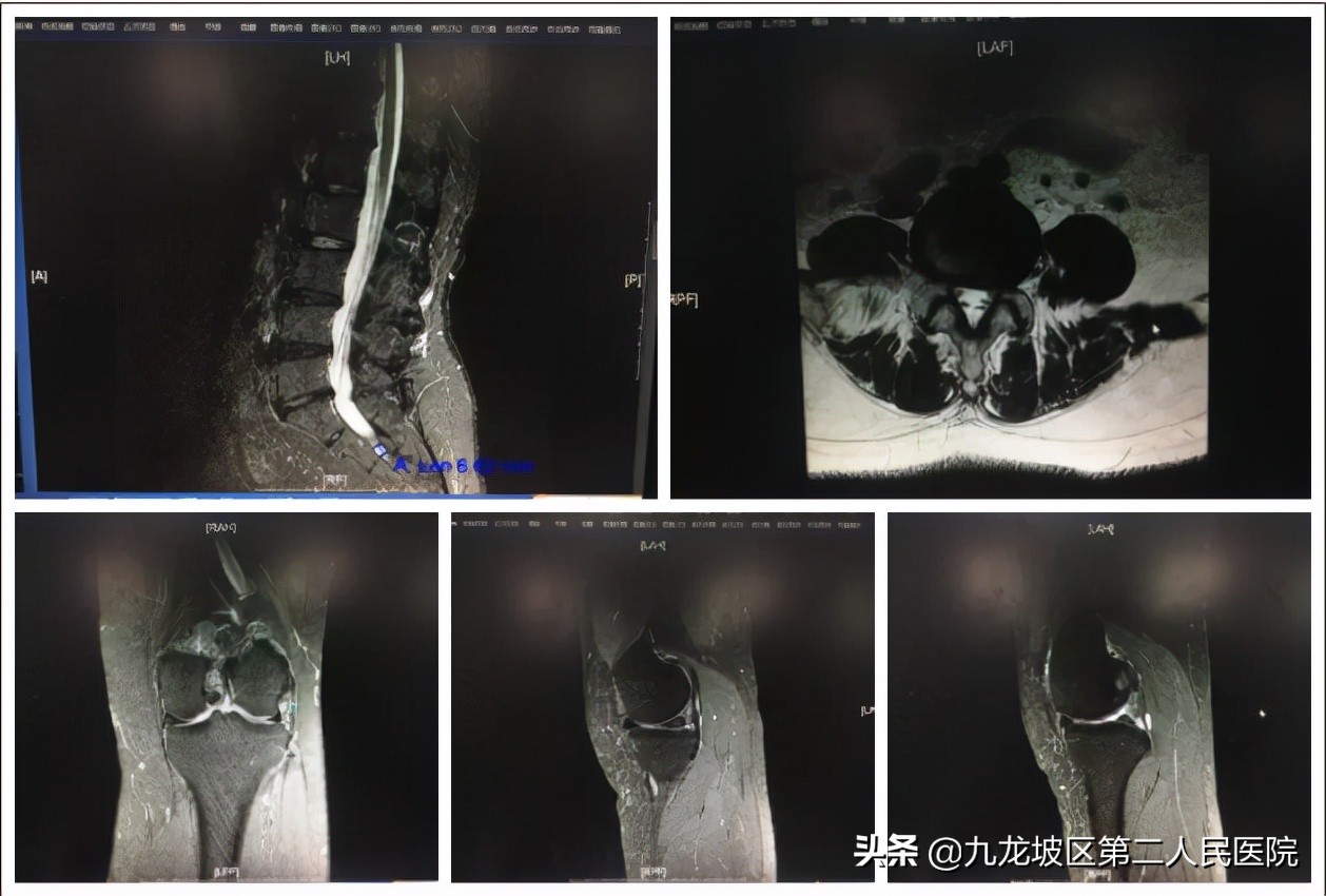 爱跳舞的向阿姨腰痛,一查腰椎、腰背部、膝关节、半月板都有伤