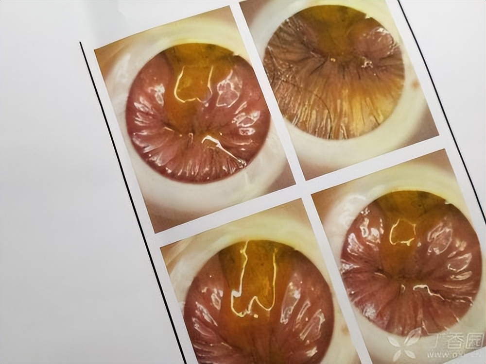 22岁女性肛裂能自愈吗,18岁女孩肛裂怎么办