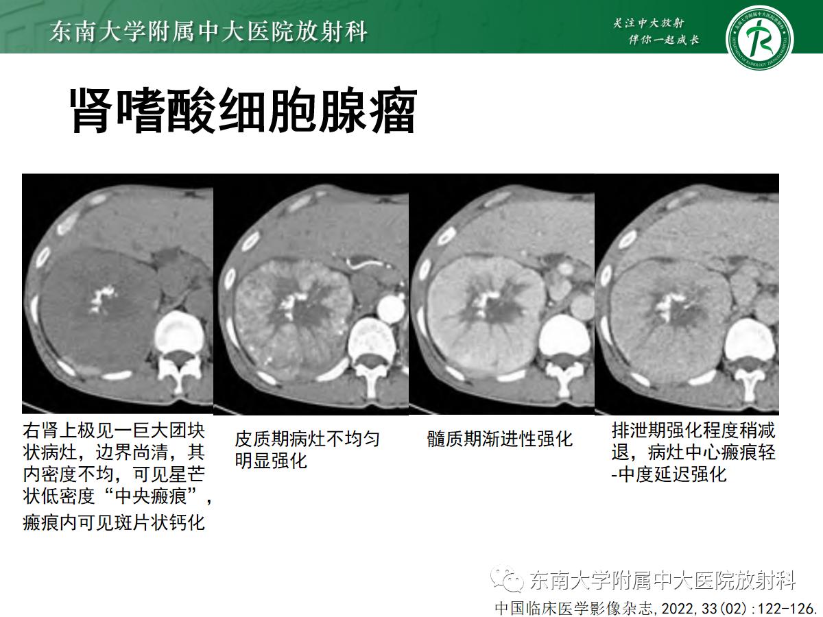 周利群谈肾嫌色细胞癌ct特点,好文分享值得深思