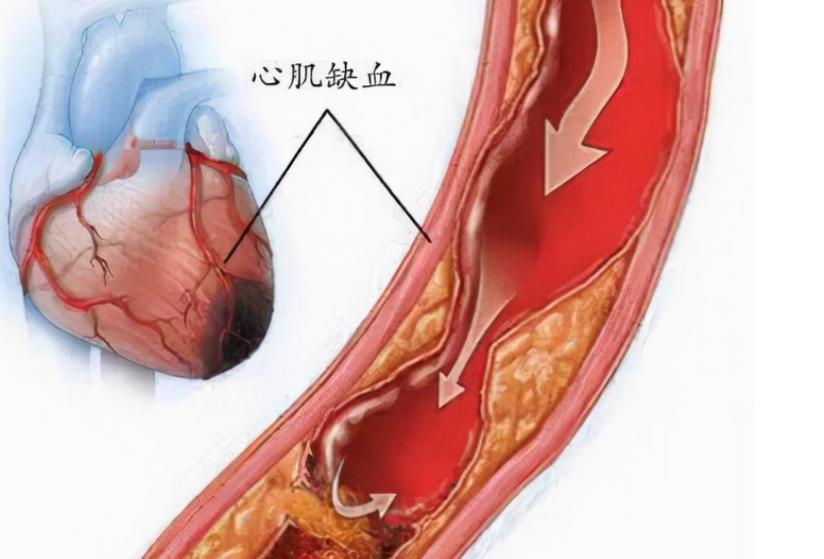 心肌缺血应该吃什么药效果好,心肌缺血吃什么药效果更好