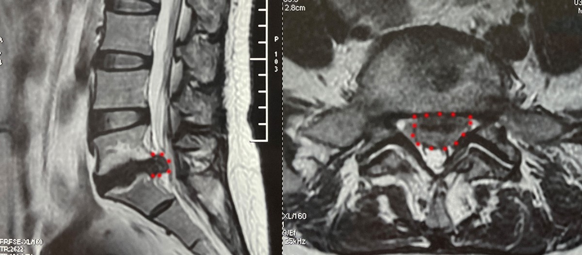 椎间盘突出微创手术对脊椎的影响,颈椎间盘突出椎管狭窄微创手术