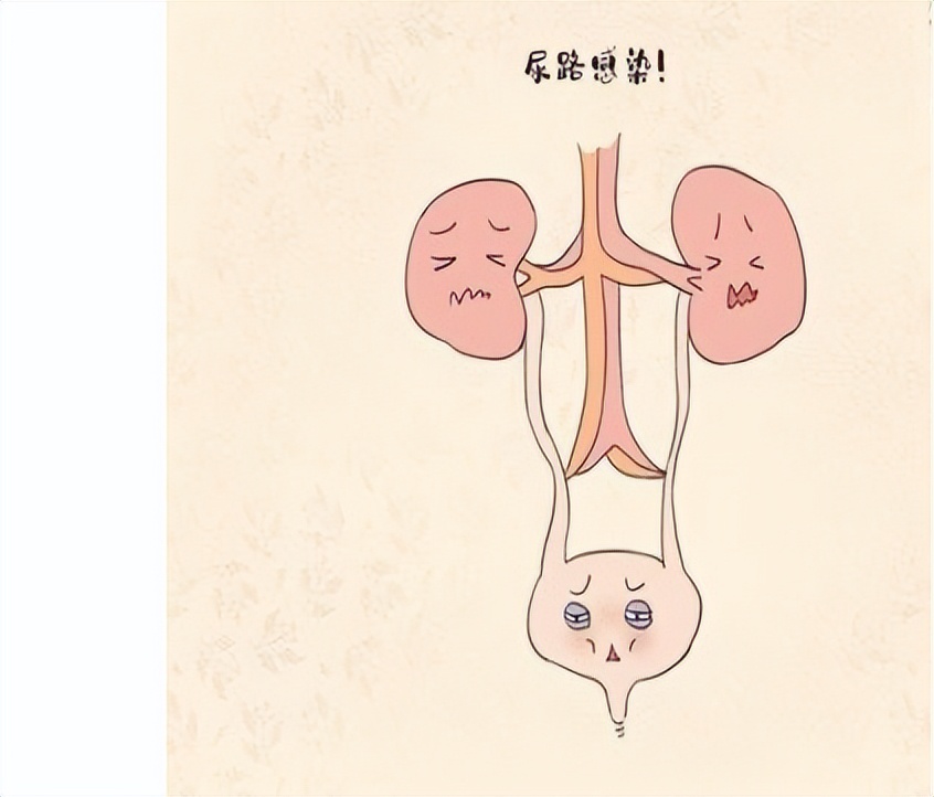 81岁男性泌尿道感染，经药物及膀胱冲洗治疗后症状消失