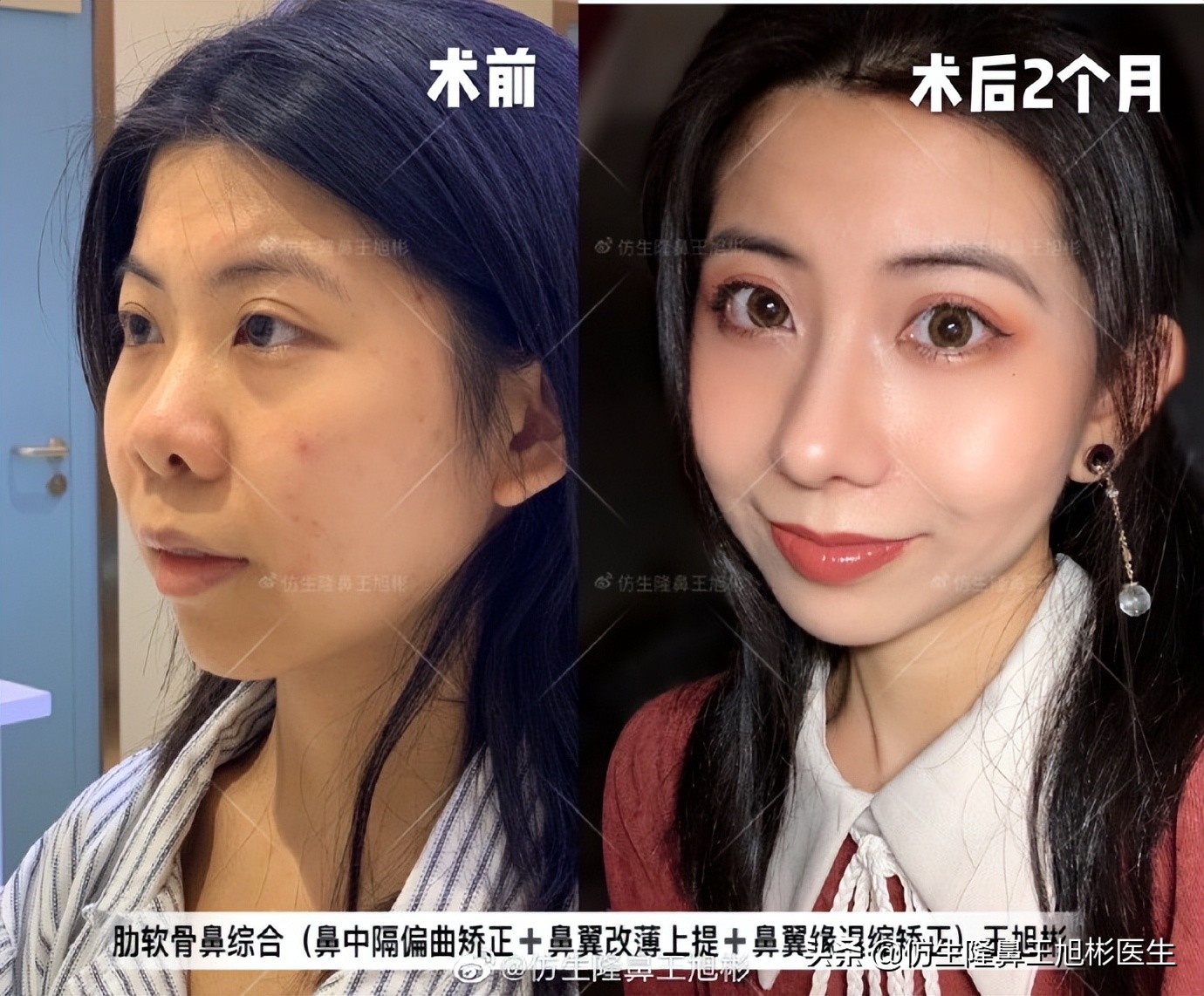 做一次鼻头缩小要多少钱好,可以只做鼻头缩鼻翼吗