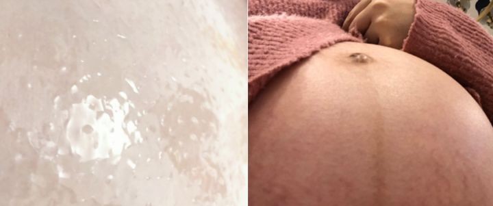 妊娠纹用什么护肤霜比较好,祛妊娠纹最好的精华霜