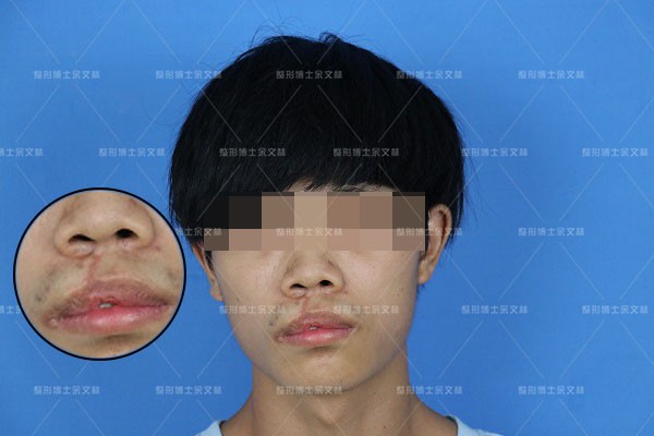 唇裂术后会出现哪些唇部畸形,唇裂造成畸形牙矫正视频