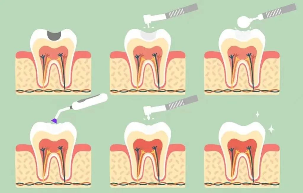 补过的牙齿可以弄掉重新补吗,补好的牙齿为什么又坏了