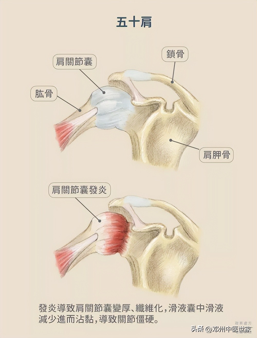 肩周炎（五十肩、肩凝）、医案