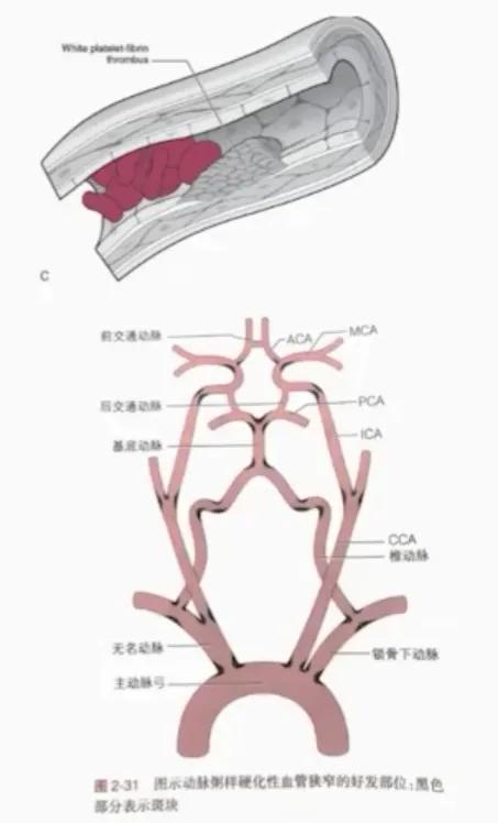 缺血性卒中治疗原则,缺血性卒中病因分型