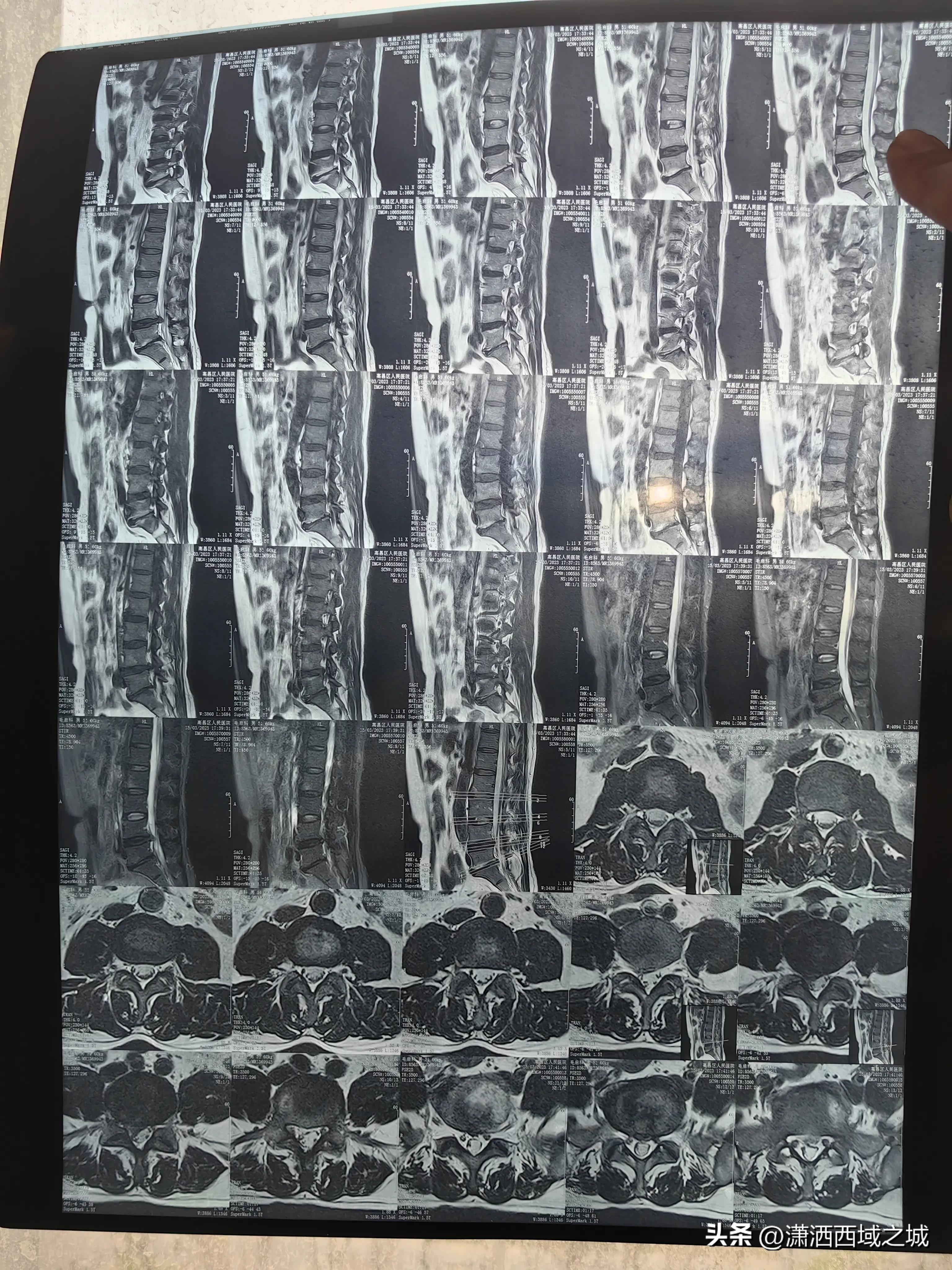 腰间盘突出痊愈口述,腰间盘突出住院治疗流程