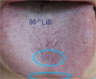 舌根部有裂纹是什么舌象,舌有裂纹7种原因通过舌象来调理