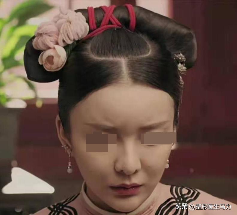 三甲医院整形医生才敢说的大实话,玻尿酸填充次数多了会有后遗症么