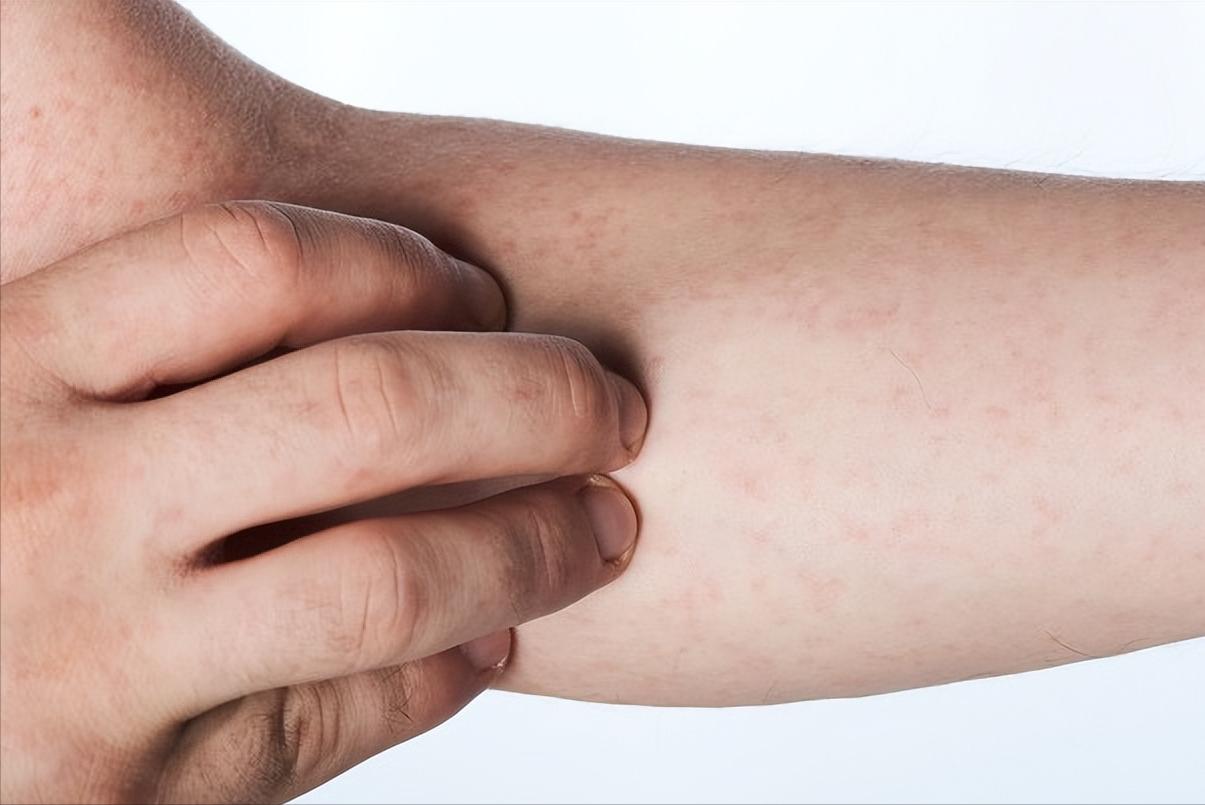 「健康科普」干燥综合症的症状是什么？如何缓解