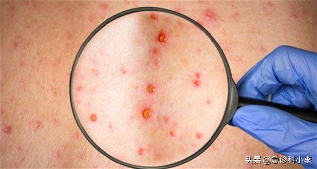 孩子身上小红点不痛不痒是什么病,身上起小红点不痛不痒按压会消失