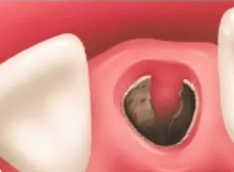 拔牙后不要频繁吐口水！当心“干槽症”找上门